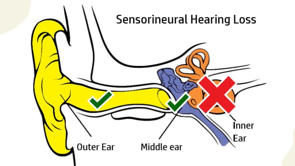 Sensorineural Types of Hearing problem