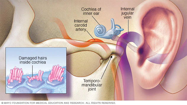 Tinnitus-Types of hearing problem