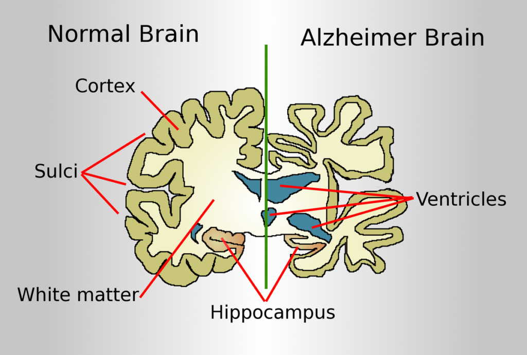healthy vs Alzheimer's brain